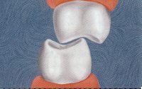 Fig. 16 Maxillary and mandibular molars in vertical contact. 