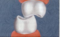 Fig.17 Maxillary and mandibular molars with off-axis occlusal forces.
