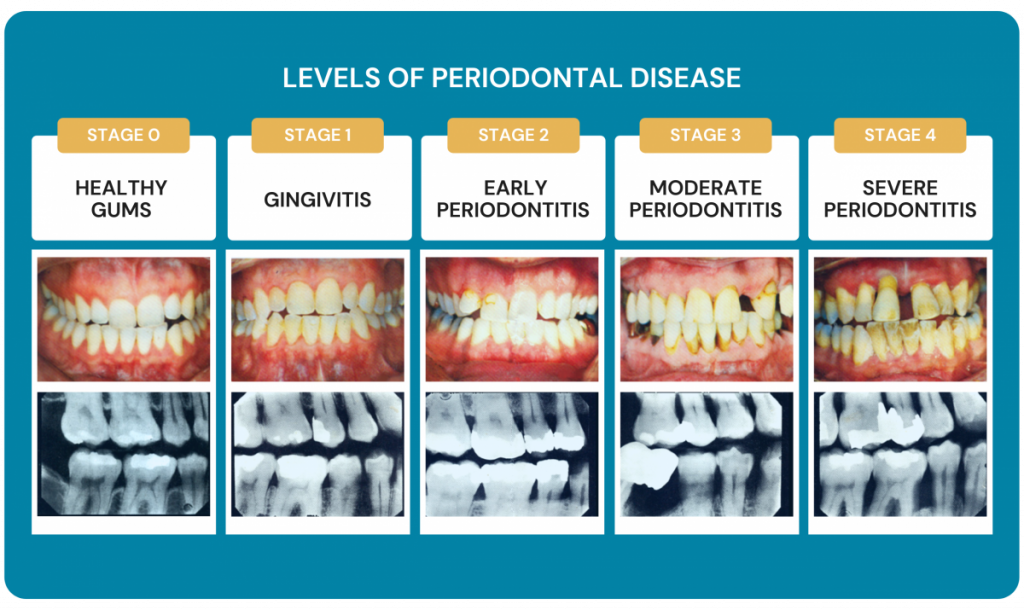 mild periodontitis